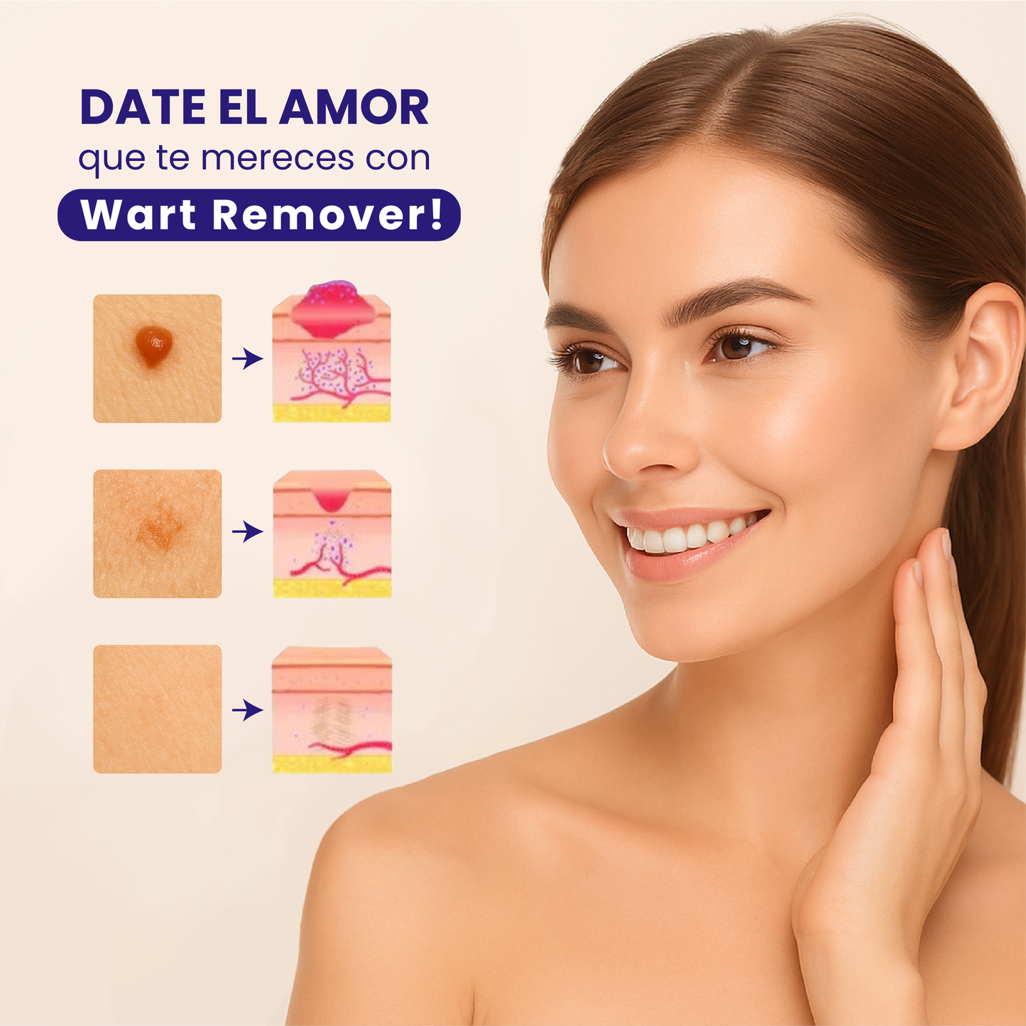 Wart Remover - Removedor de verrugas